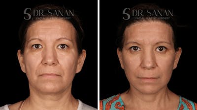 Blepharoplasty Before & After Gallery - Patient 333124 - Image 1