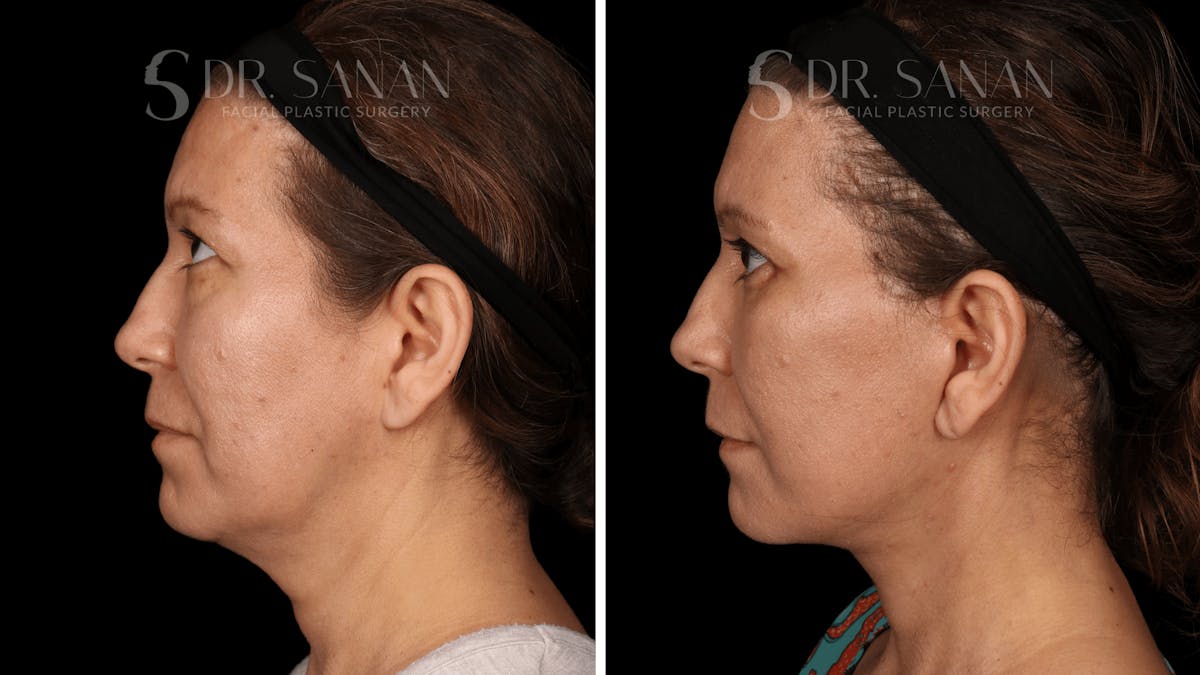 Blepharoplasty Before & After Gallery - Patient 333124 - Image 6