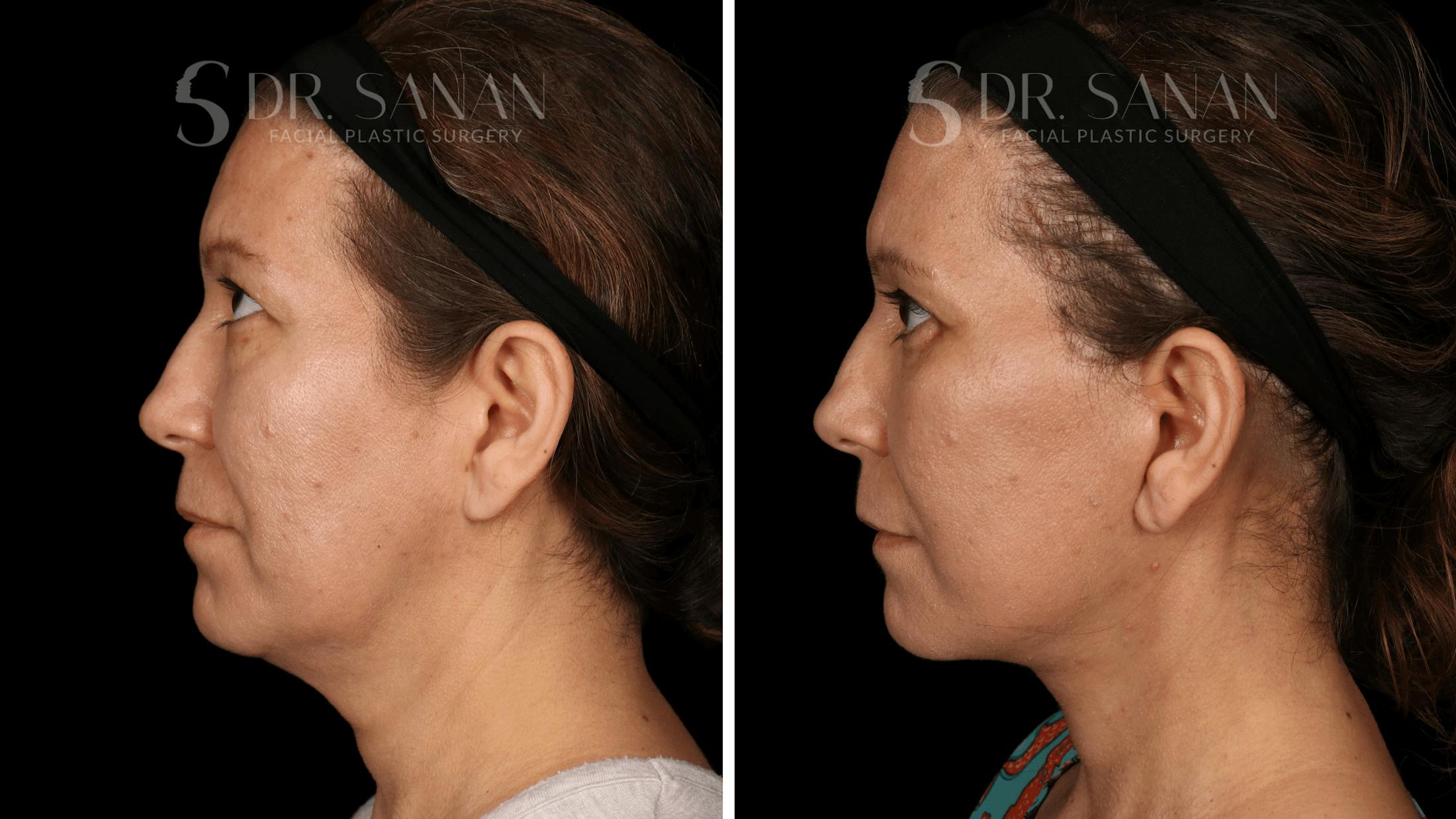 Blepharoplasty Before & After Gallery - Patient 333124 - Image 6
