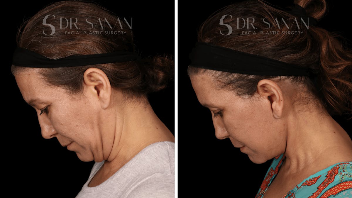 Blepharoplasty Before & After Gallery - Patient 333124 - Image 7