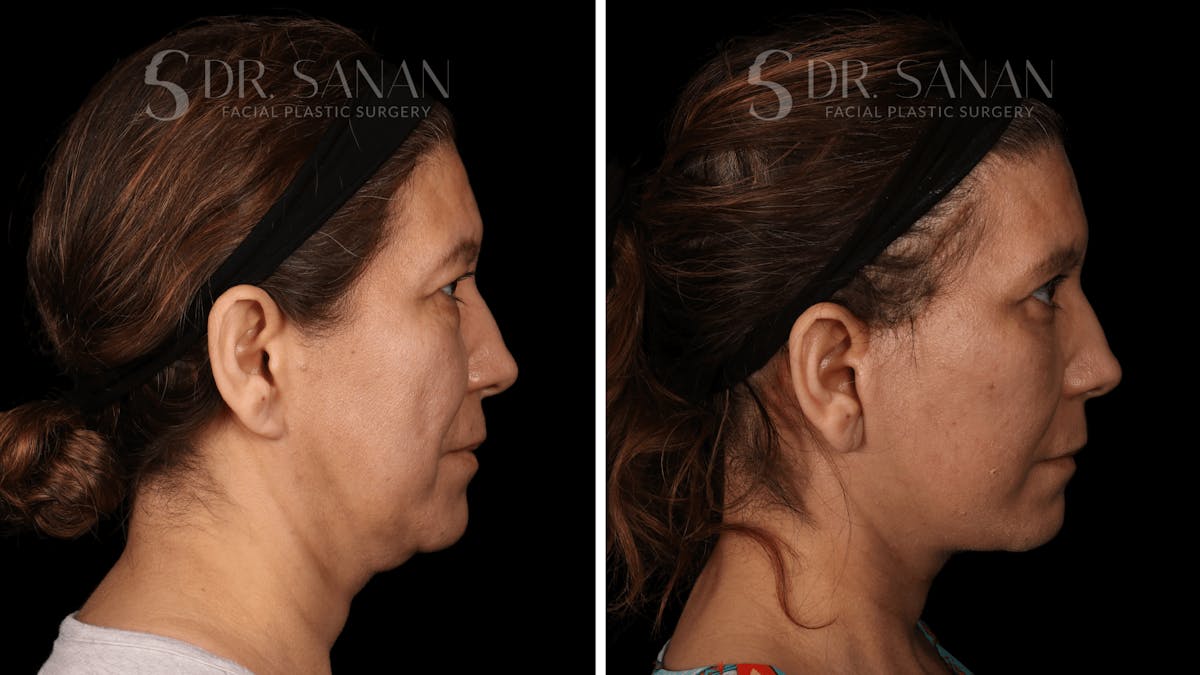 Blepharoplasty Before & After Gallery - Patient 333124 - Image 3