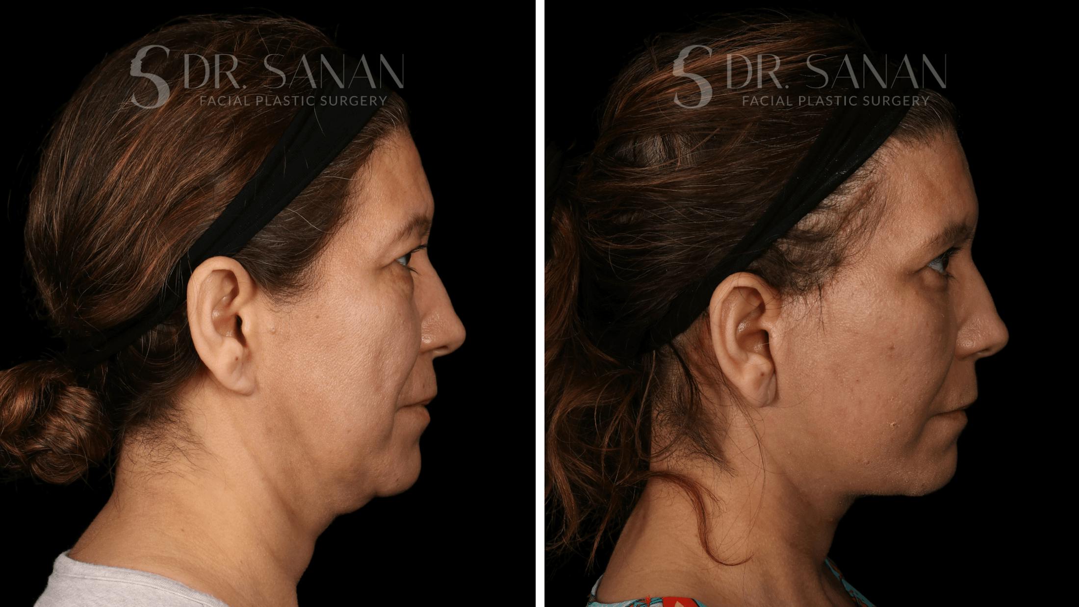 Blepharoplasty Before & After Gallery - Patient 333124 - Image 3