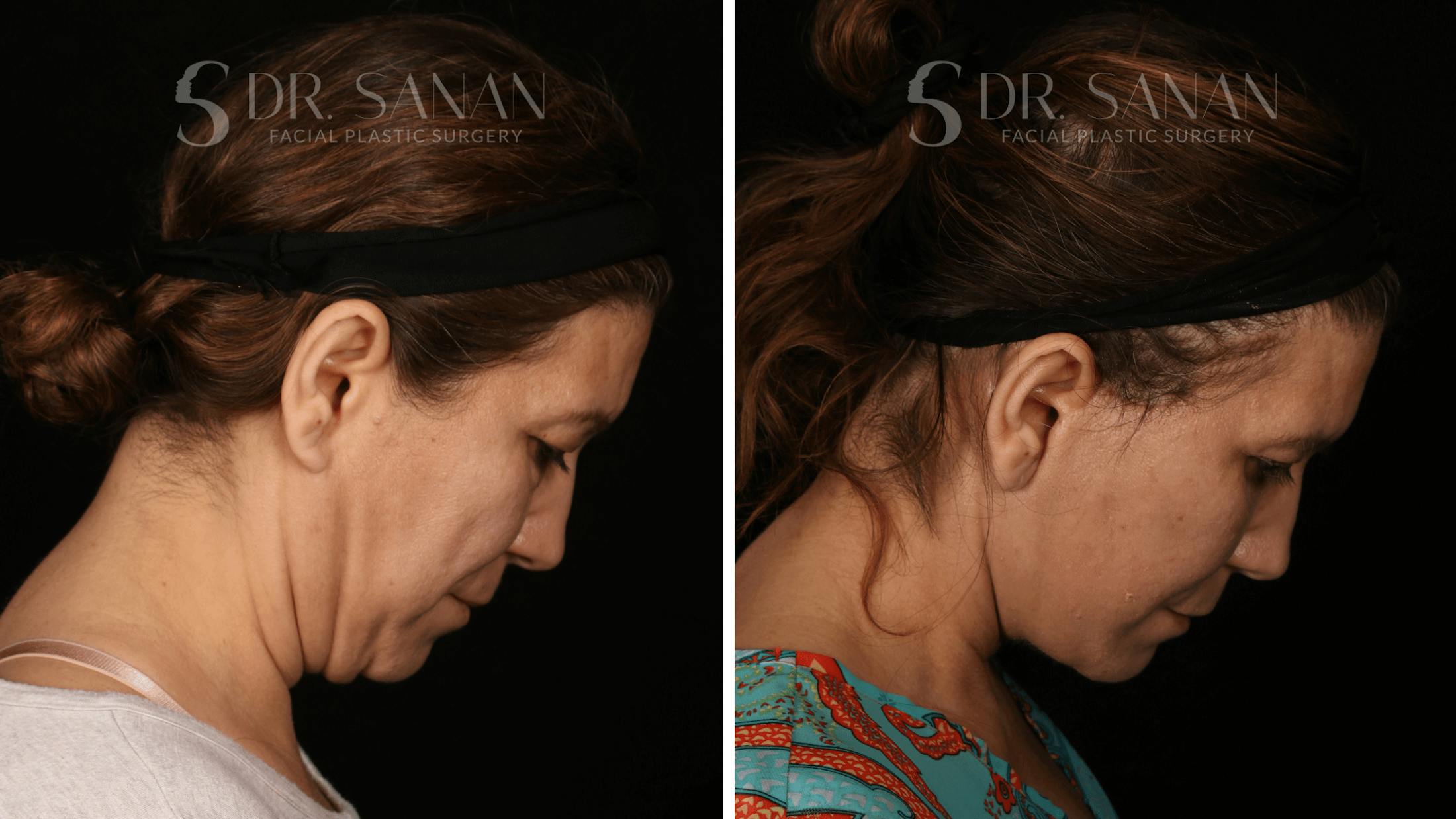 Blepharoplasty Before & After Gallery - Patient 333124 - Image 4