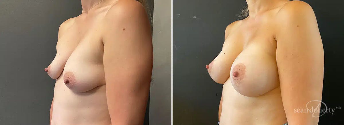 Breast Lift with Implants Before & After Gallery - Patient 190086 - Image 2