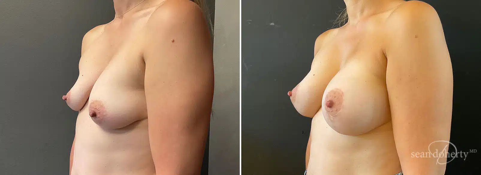 Breast Augmentation Before & After Gallery - Patient 118117 - Image 2