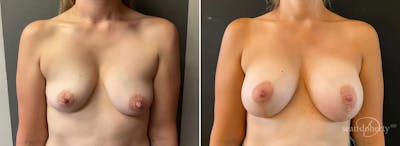 Breast Lift with Implants Before & After Gallery - Patient 190086 - Image 1