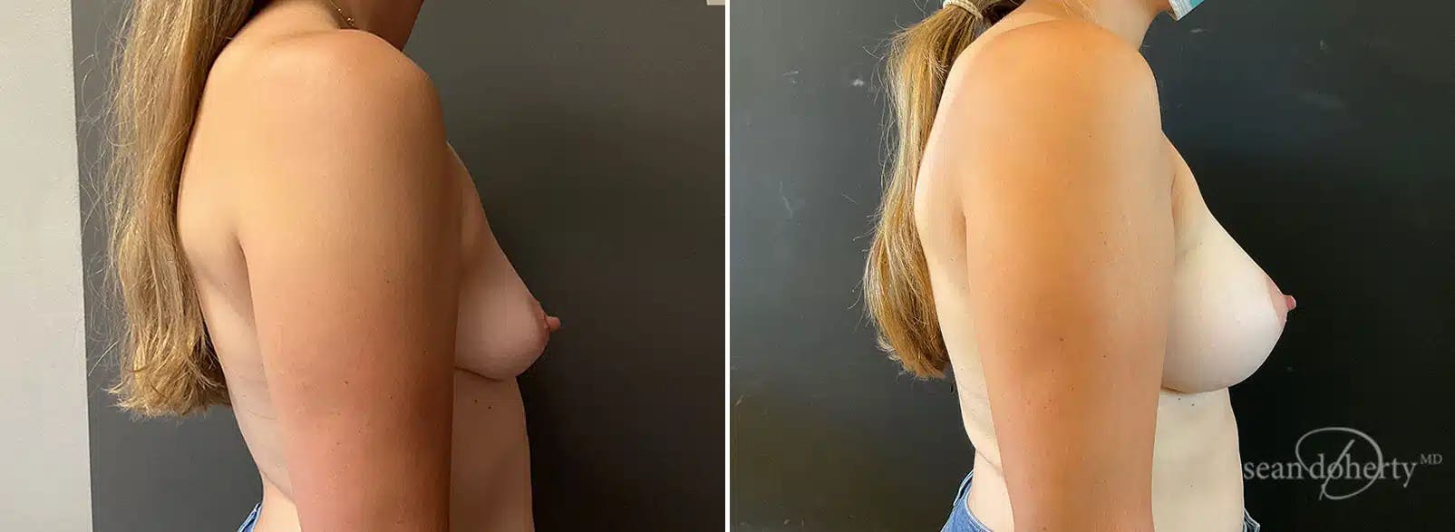Breast Augmentation Before & After Gallery - Patient 118117 - Image 3