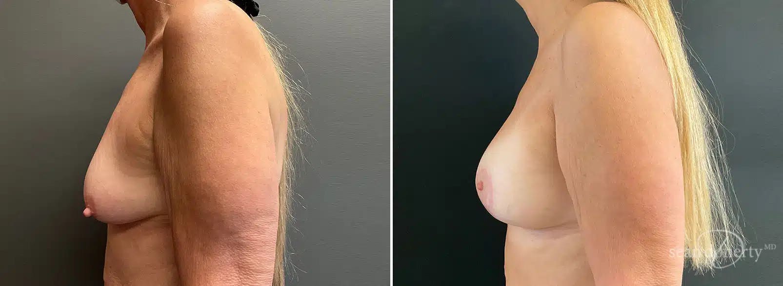 Breast Augmentation Before & After Gallery - Patient 295748 - Image 3