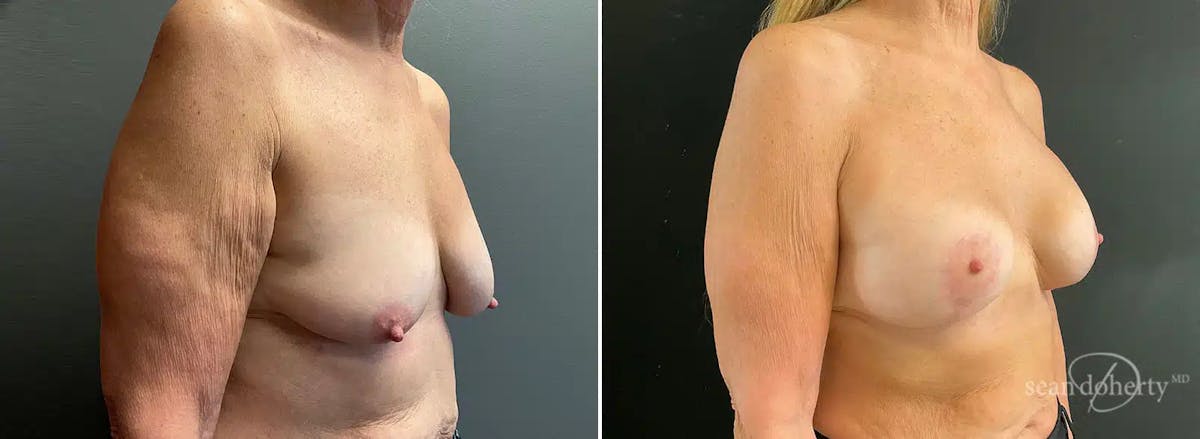 Breast Lift with Implants Before & After Gallery - Patient 543651 - Image 2