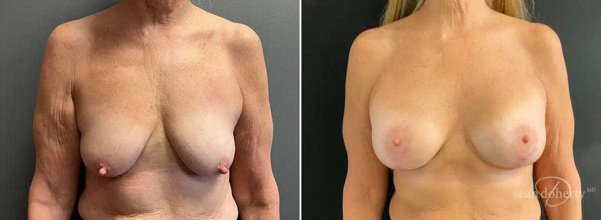 Breast Lift with Implants Before & After Gallery - Patient 543651 - Image 1