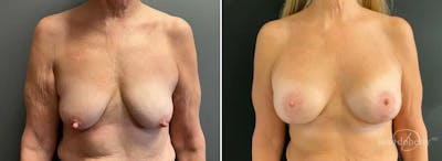 Breast Lift with Implants Before & After Gallery - Patient 543651 - Image 1