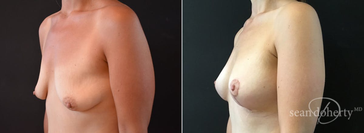 Breast Lift with Implants Before & After Gallery - Patient 183514 - Image 2