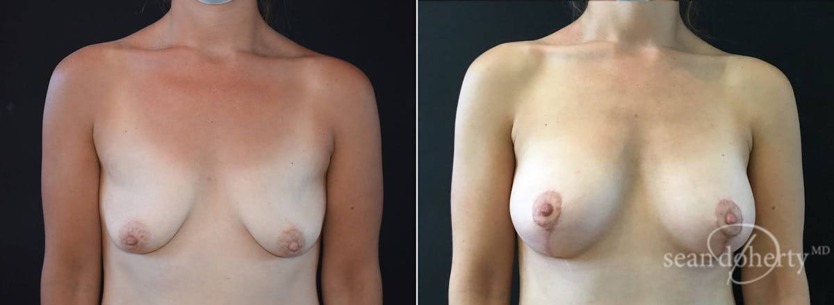 Breast Lift with Implants Before & After Gallery - Patient 183514 - Image 1