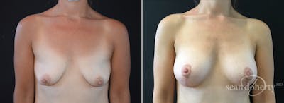 Breast Lift with Implants Before & After Gallery - Patient 183514 - Image 1