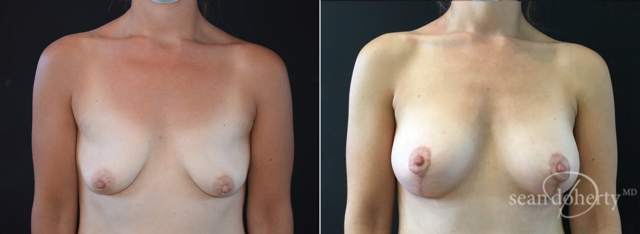Breast Augmentation Before & After Gallery - Patient 147797 - Image 1