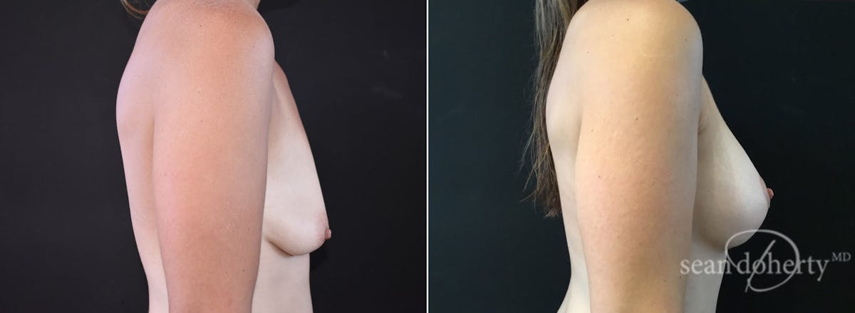 Breast Lift with Implants Before & After Gallery - Patient 183514 - Image 3