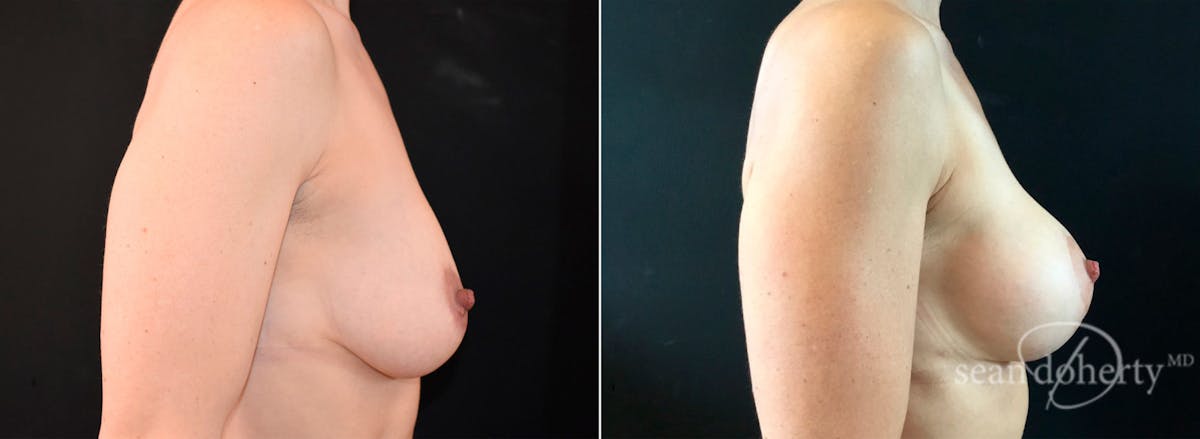 Breast Lift with Implants Before & After Gallery - Patient 342086 - Image 3