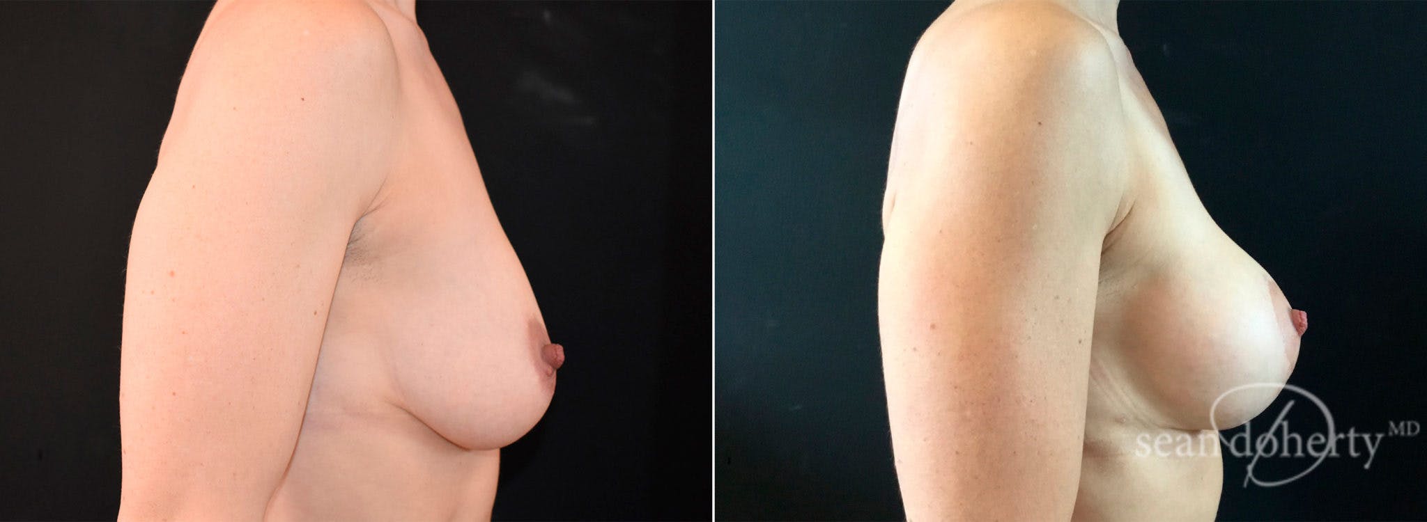 Breast Augmentation Before & After Gallery - Patient 397339 - Image 3