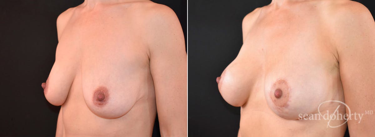 Breast Lift with Implants Before & After Gallery - Patient 342086 - Image 2