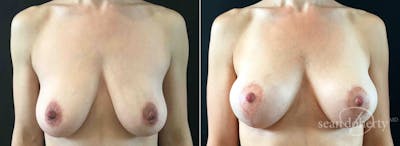Breast Lift with Implants Before & After Gallery - Patient 342086 - Image 1