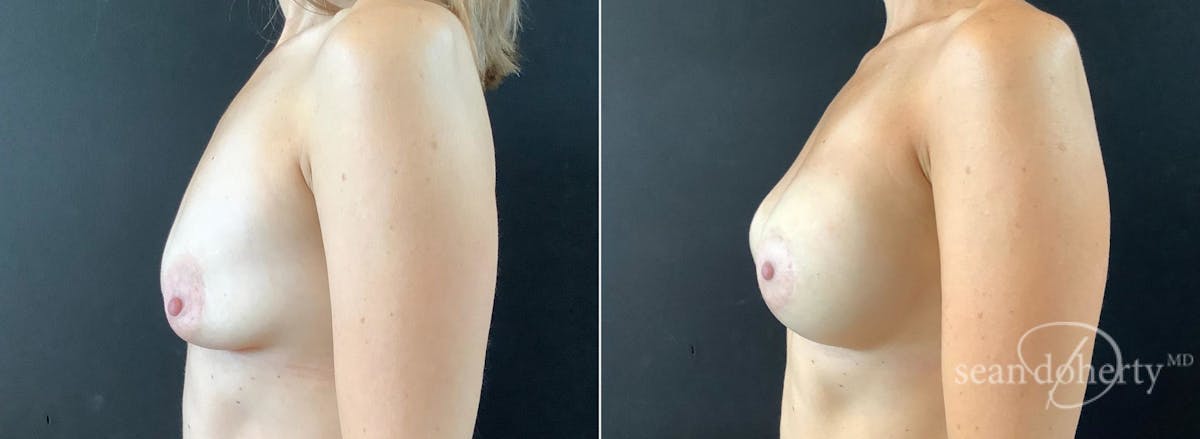 Breast Lift with Implants Before & After Gallery - Patient 330780 - Image 3