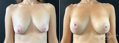 Breast Lift with Implants Before & After Gallery - Patient 330780 - Image 1