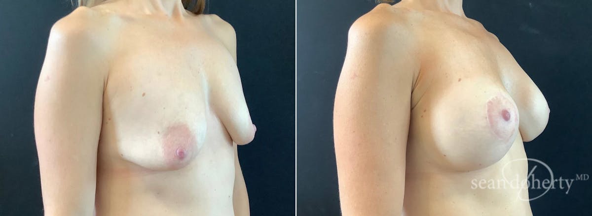 Breast Lift with Implants Before & After Gallery - Patient 330780 - Image 2