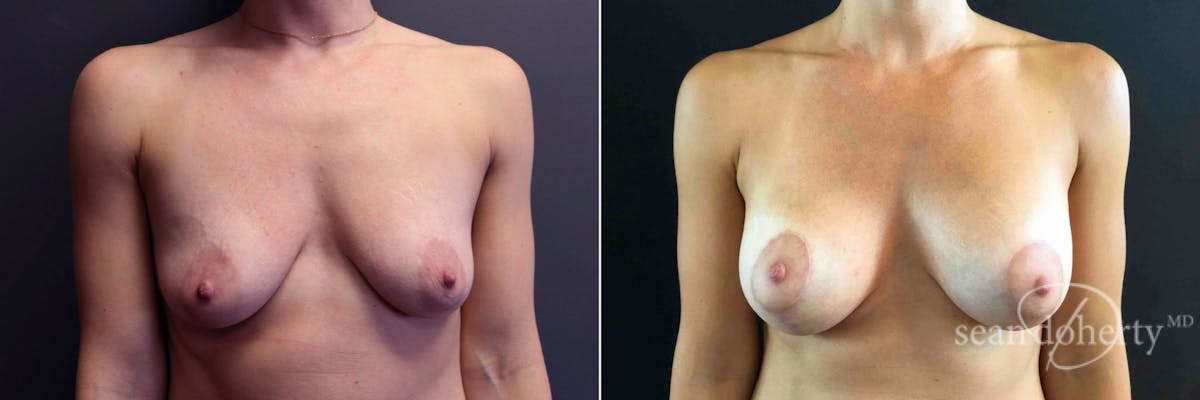 Breast Lift with Implants Before & After Gallery - Patient 104526 - Image 1