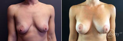 Breast Lift with Implants Before & After Gallery - Patient 104526 - Image 1