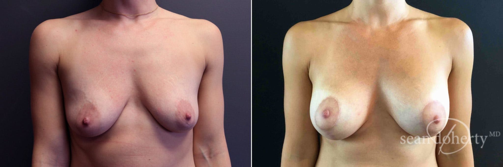 Breast Augmentation Before & After Gallery - Patient 447880 - Image 1