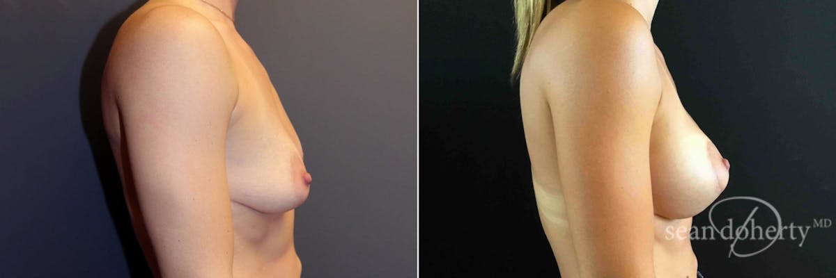 Breast Lift with Implants Before & After Gallery - Patient 104526 - Image 3