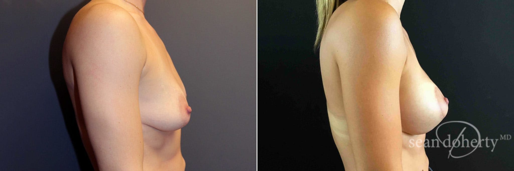 Breast Augmentation Before & After Gallery - Patient 447880 - Image 3