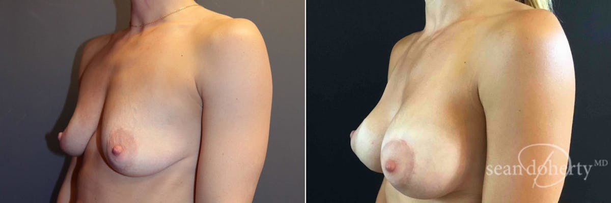Breast Lift with Implants Before & After Gallery - Patient 104526 - Image 2
