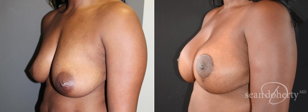 Breast Lift with Implants Before & After Gallery - Patient 342861 - Image 2