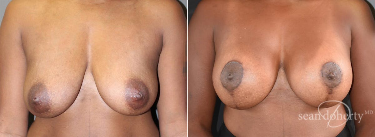 Breast Lift with Implants Before & After Gallery - Patient 342861 - Image 1