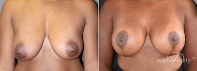 Breast Lift with Implants Before & After Gallery - Patient 342861 - Image 1