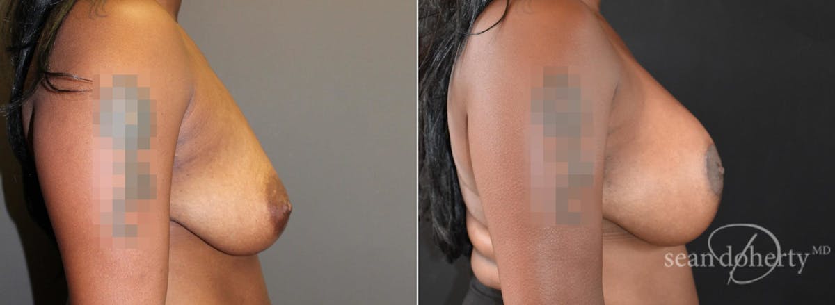 Breast Lift with Implants Before & After Gallery - Patient 342861 - Image 3