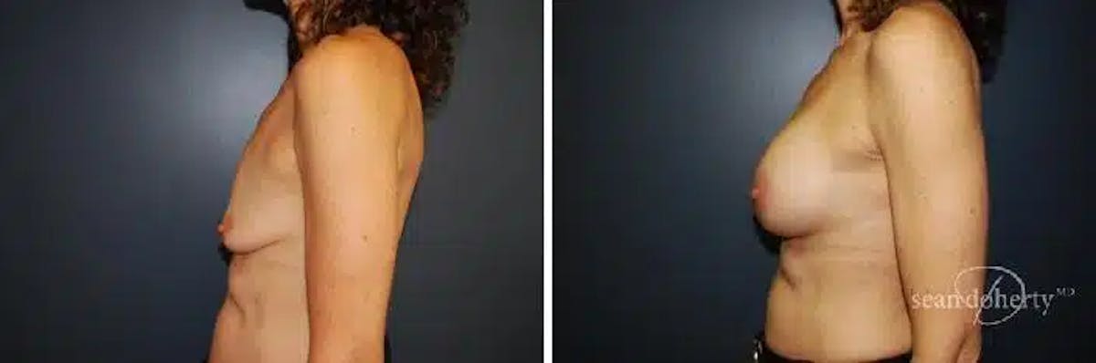 Breast Lift with Implants Before & After Gallery - Patient 318464 - Image 5