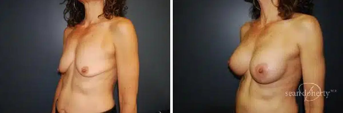Breast Lift with Implants Before & After Gallery - Patient 318464 - Image 4