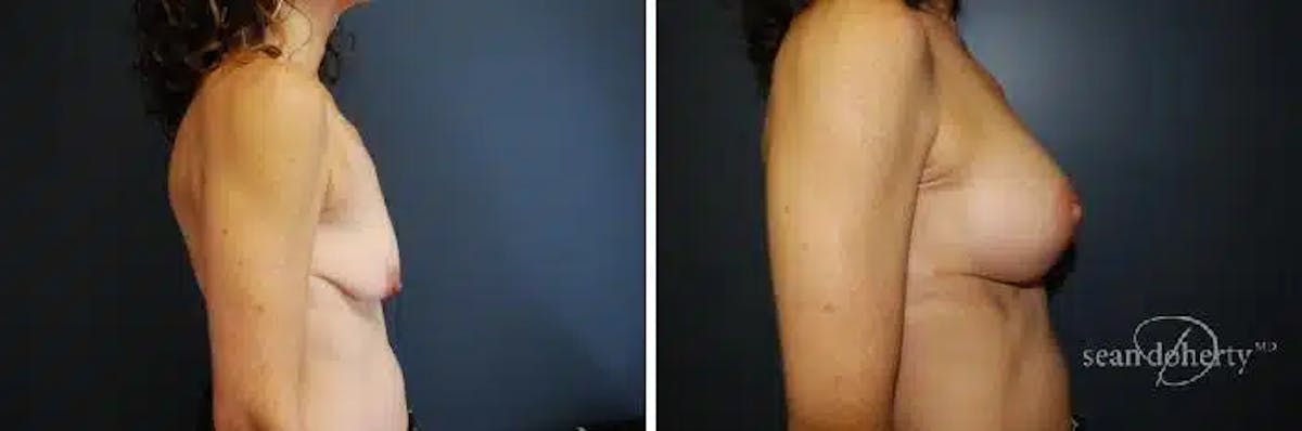 Breast Lift with Implants Before & After Gallery - Patient 318464 - Image 3