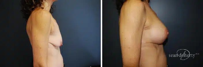 Breast Augmentation Before & After Gallery - Patient 271986 - Image 3