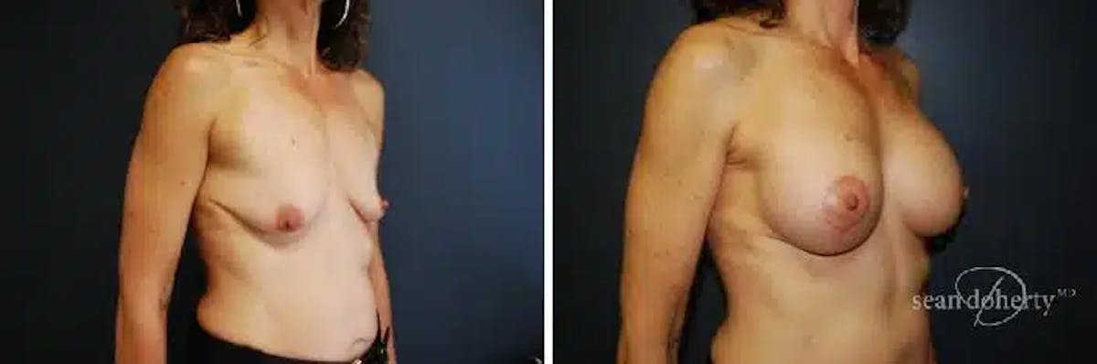 Breast Lift with Implants Before & After Gallery - Patient 318464 - Image 2