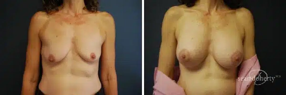 Breast Lift with Implants Before & After Gallery - Patient 318464 - Image 1