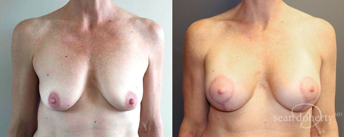 Breast Lift with Implants Before & After Gallery - Patient 253990 - Image 1