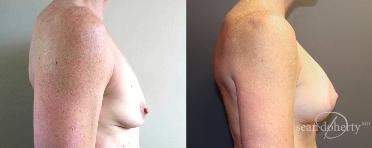 Breast Lift with Implants Before & After Gallery - Patient 253990 - Image 3