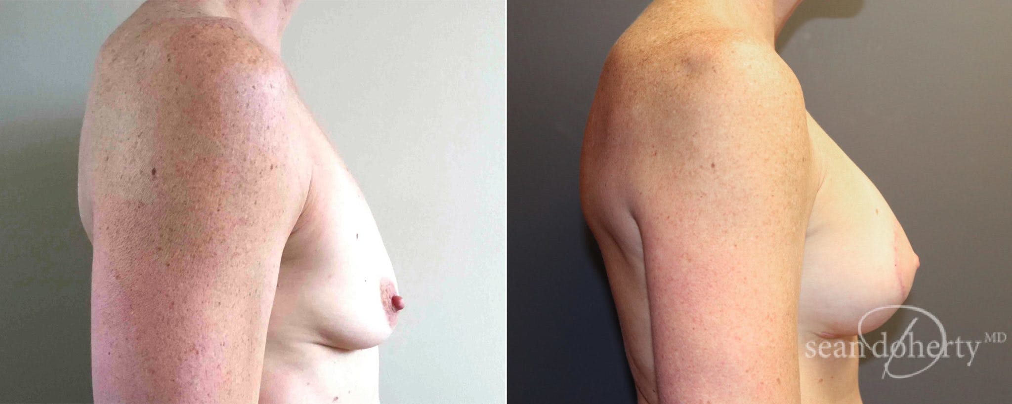 Breast Augmentation Before & After Gallery - Patient 352569 - Image 3