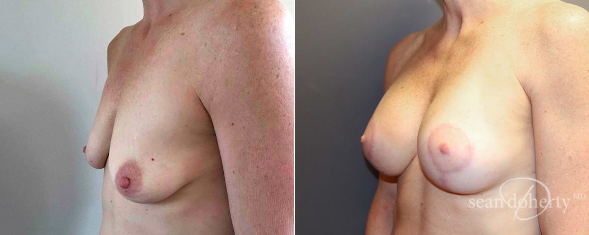 Breast Lift with Implants Before & After Gallery - Patient 253990 - Image 2