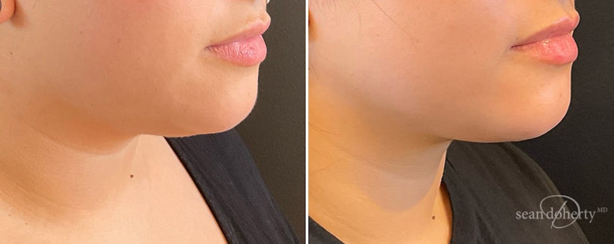 Liposuction Before & After Gallery - Patient 251901 - Image 2