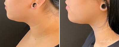 Liposuction Before & After Gallery - Patient 251901 - Image 1