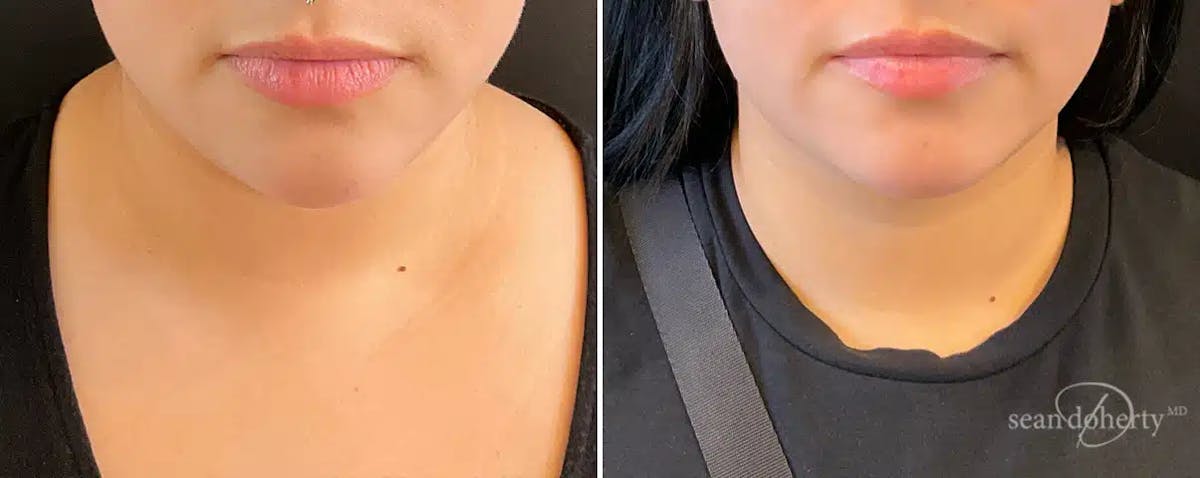 Liposuction Before & After Gallery - Patient 251901 - Image 3